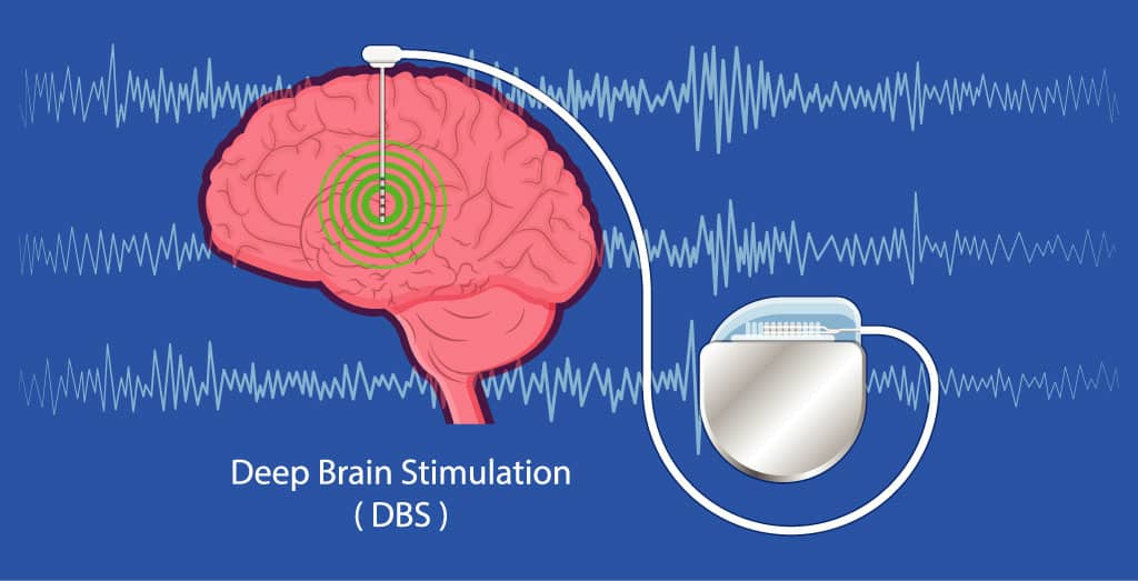 Tiny electrodes in the brain to fight depression IBSA Foundation